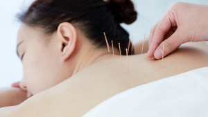 Read more about the article How Acupuncture Works to Ease Chronic Pain | My Rapid Relief