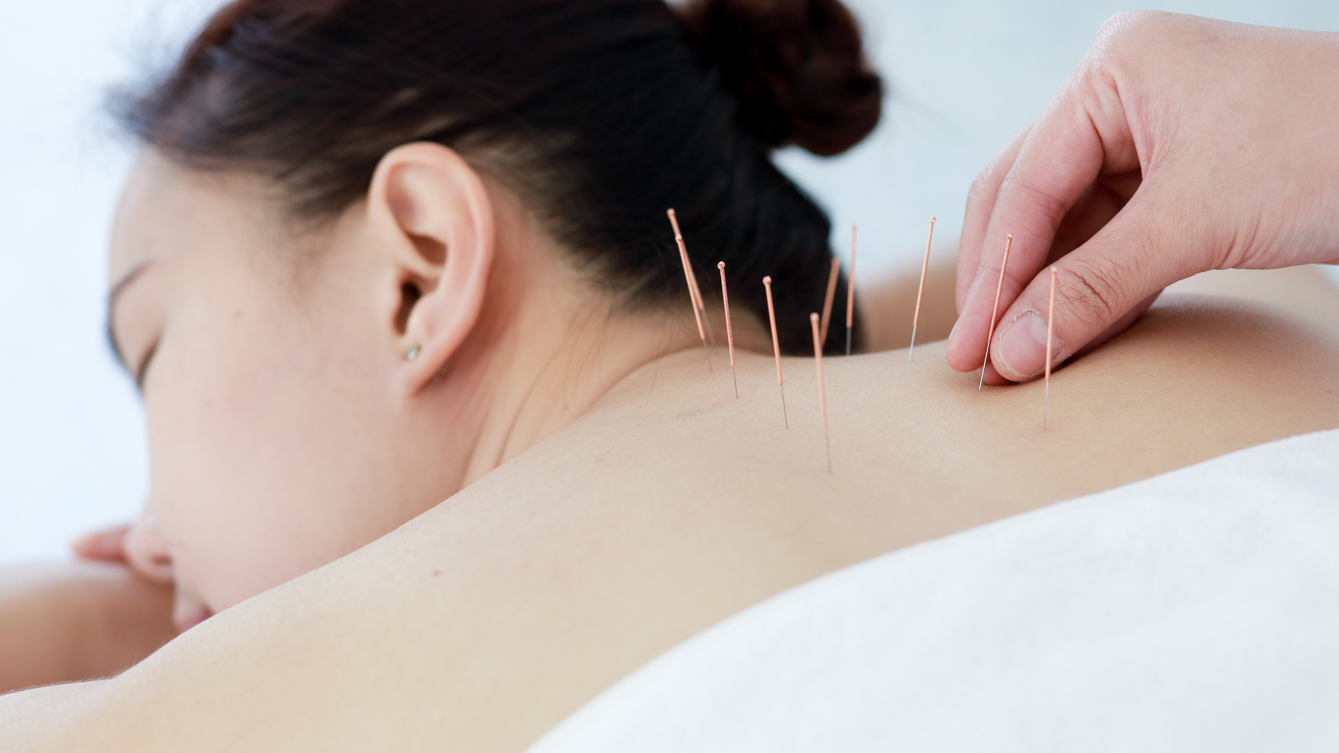 Read more about the article How Acupuncture Works to Ease Chronic Pain | My Rapid Relief